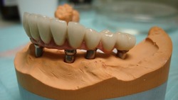 Ахтубинцев приглашают на льготное протезирование зубов